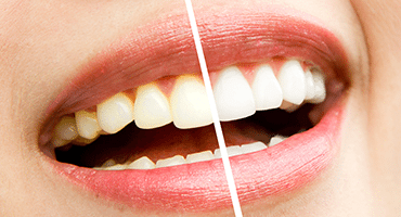 Teeth Whitening | The Smile Center
