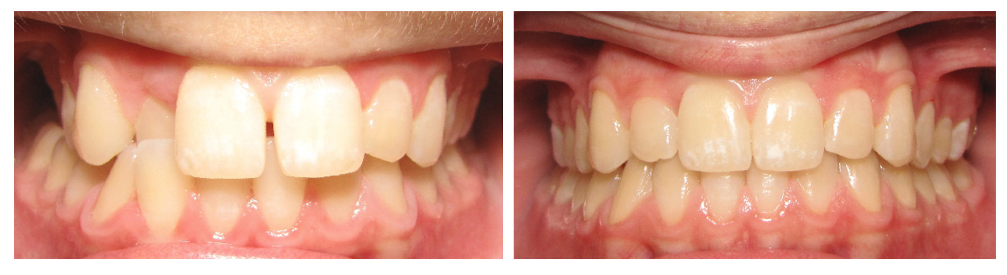 Before and After view of teeth fixed with invisalign